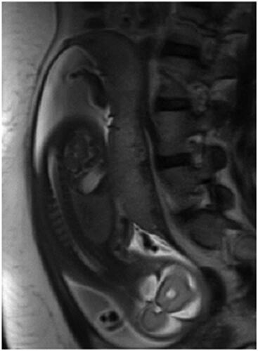 Figure 1. Sagittal HASTE image through the placenta.