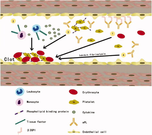 Figure 1. Thrombotic mechanisms mediated by aPL. Thrombus formation can be promoted in the different ways [Citation1]: aPL interacts with endothelial cells [Citation2]; aPL activates mononuclear cells, induces expression of tissue factors, proteinase activated receptors and proinflammatory cytokines [Citation3]; aPL interacts with platelets [Citation4]; aPL inhibit fibrinolysis.aPL:antiphospholipid antibodies; β2-GPI:β2-glycoprotein I.