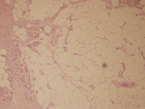 Figure 3. Histological view of the angiofibrolipoma.