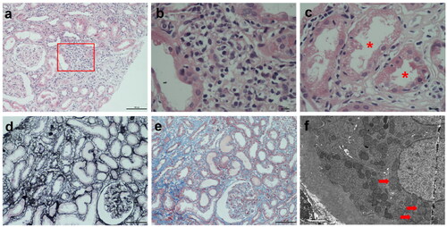 Figure 1. PBC-PT patients presented with tubulointerstitial nephritis in kidney biopsy. (a) Focal interstitial inflammatory infiltrates with major components of lymphocytes and plasma cells were shown by HE staining (×100). (b) Enlarged boxed area in (a) (×400). (c) Proximal tubulitis characterized as inflammatory cell infiltration in proximal tubular epithelium (asterisks) was revealed by HE staining (×400). (d) Focal tubular atrophy was shown by periodic acid-silver metheramine staining (×100). (e) Focal interstitial fibrosis was indicated by masson trichrome staining (×100). (f) Swollen mitochondria with destroyed or disappeared cristae (arrows) in proximal tubular epithelium were shown by transmission electron microscopy (×5000). Abbreviations: PBC-PT, primary biliary cholangitis with proximal tubular dysfunctions; HE, hematoxylin and eosin staining.