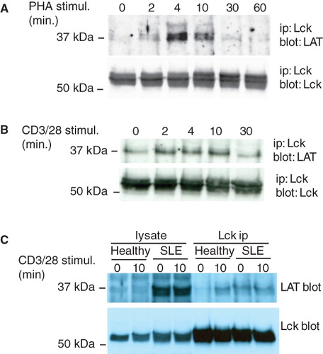 Figure 1. LAT associates with the active form of Lck. (A) Jurkat T cells (107) were stimulated with 5 μg/ml PHA for the times indicated and Lck was immunoprecipitated. Immune complexes were analyzed with anti-LAT (upper panel) and anti-Lck (lower panel) antibodies. (B) Lck immunoprecipitations from Jurkat T cells stimulated with beads coated with anti-CD3/CD28 antibodies for the indicated times. (C) 5 × 106 purified T cells from a healthy volunteer and a patient with active SLE were left unstimulated or stimulated with anti-CD3/CD28. Immunoprecipitated Lck and associated LAT were detected with specific antibodies. The experiment shown is one out of three performed with T cells from different donors with similar result.