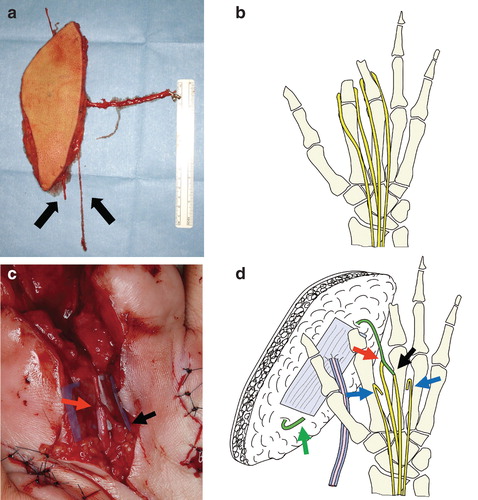 Figure 3. (a) A free anterolateral thigh flap (7 × 23 cm) was designed and harvested with its cutaneous nerve (arrows). (b) Schematic diagram of the digital nerves. (c) Intraoperative photo showing end-to-end (black arrow) and end-to-side (red arrow) neurorrhaphy between the digital nerves and cutaneous nerve of the flap. (d) Schematic diagram of the procedure. After releasing the contracture between the two stumps, the digital nerves between them are coapted to the cutaneous nerve of the flap using end-to-end (black arrow) and end-to-side (red arrow) neurorrhaphy. The other end of the cutaneous nerve of the flap is buried deeply in the soft tissue (green arrow). The other digital nerves are refreshed for about 3 cm and buried deeply in the muscle (blue arrows).