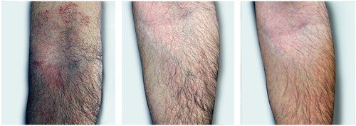 Figure 5. This very pruritic dermatitis of the antecubital fossa was rapidly contained by the treatment.