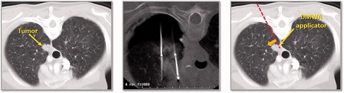 Figure 4. CT image of 1.3 cm para-mediastinal tumor (yellow arrow) adjacent to esophagus in a patient at high risk for surgery (left image). CT image of an induced pneumothorax and ‘chopstick’ technique to treat the tumor with existing cryoablation probes (middle image). Illustration of hypothetical DMWA applicator placement (red dashed line) and direction of microwave emission (orange arrow) to treat the tumor and avoid the esophagus (right image).