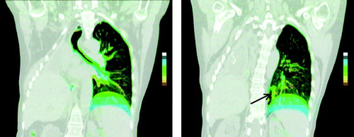 Figure 5.  CIP images of a patient with a prior right pneumonectomy, showing mobility of the left diaphragm and left main stem bronchus (left). A tumor in the left lower lobe shows predominantly cranio-caudal mobility (arrow) and the colored ‘column’ indicates the trajectory of mobility. The green color of the most cranial position indicates that the tumor is at its end-expiratory position for 50% of the respiratory cycle.