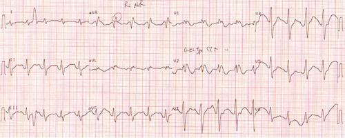 Fig. 3.  A 12-lead ECG showing recurrence of BEP after 14 h admitted to ICU.