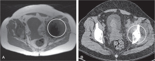 Figure 2. Large pseudotumor (circled) clearly visible on both MARS MRI scan (A) and CT scan (B), as the anatomy of the affected side is grossly distorted when compared to the contralateral, asymptomatic hip.