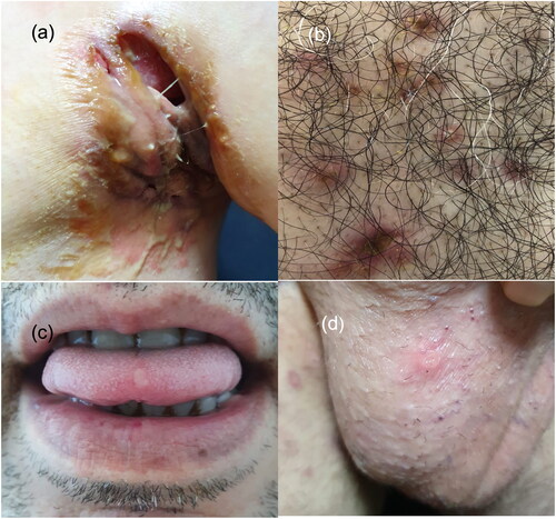 Figure 1. (a) Ulcerations with undermined and erythematous borders on the left axillary fold where diffuse sinus tracts and abscesses are also seen. (b) Hyperemic papulopustular lesions and an ulceration on the sternum. (c) and (d) Oral and genital aphthous ulcerations.