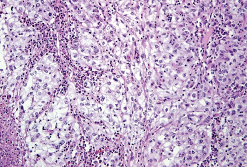 Figure 2. Histopathology showing RCC cells in an alveolar arrangement with clear cytoplasm.