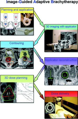 Figure 2.  Treatment chain for 4D image-guided adaptive cervix cancer brachytherapy using MRI.