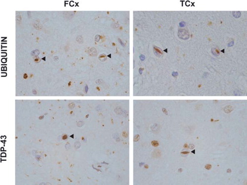 Figure 2. TDP-43 proteinopathy in FTLD. Ubiquitin and TDP-43 immunohistochemistry of sections from the superficial frontal cortex (FCx) and temporal cortex (TCx) of a patient with a VCP mutation (Citation176). Frequent intranuclear inclusions (arrow-heads) are seen that stain positive for ubiquitin and TDP-43.