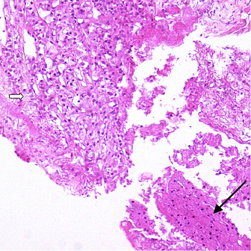 Figure 1.  Fine needle biopsy from the liver with clear cell carcinoma (Hematoxilin and eosin×20). Liver parenchyma is marked with long arrow, tumour tissue with short, broad arrow.