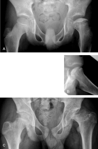 Figure 2. A 9-year-old boy with Perthes' disease of the left hip. He had had pain in his left knee and limping for 2 months prior to diagnosis. A and B. At the time of diagnosis, showing Perthes' disease classified as Catterall group 4 and lateral pillar group C. C. At 5-year follow-up, showing poor radiographic outcome with flattened left femoral head.