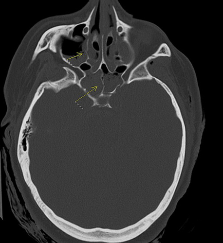 Figure 8 Axial view of the head CT. (Upper arrow: maxillary sinus medial wall fracture due to force of penetrating trauma) (Lower arrow: medial sphenoid septum fracture due to force of penetrating trauma).