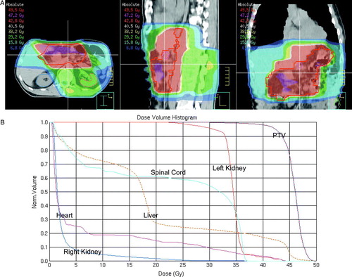 Figure 1.  Adjuvant radiotherapy after distal subtotal gastrectomy (A) 3D dose plan. The red line depicts the planning target volume (PTV) and the red area 95% of the prescribed dose (B) Dose volume histograms for the PTV and organs at risk.