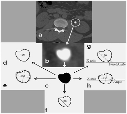 Figure 1. (a–h) Especially, a calculus that shows the stages in processing some of the parameters that are statistically significant in the ImageJ programme (a) original axial CT image, (b) the cut zone from the image, (c) the black-white image after running threshold command, (d) determination of the border of object, (e) drawing of an ellipse best fit to the border of object, (f) Feret diameter of object, (g) measuring the angle, (h) measuring the Feret angle.