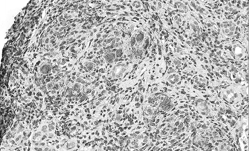 Figure 3.  Immunostaining for CD68: an interstitial granuloma with infiltrating monocytes (CD68+).