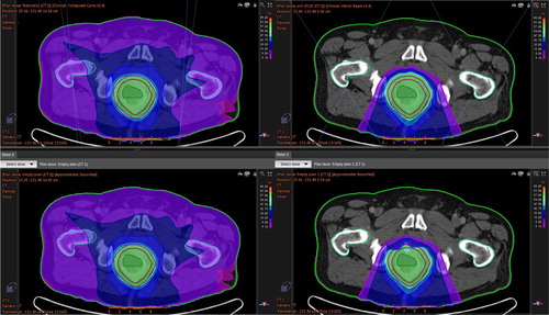 Figure 4. Differences in target coverage – intestinal gas influence in patient no 3. Photon plan to the left and proton plan to the right. Upper row: Dose distribution in the planning CT with gas present. Lower row: Dose distribution when gas is replaced by water in 25 of 25 fractions. It is the distance the protons have to cross in the gas cavity that is important for the robustness of the proton plan.