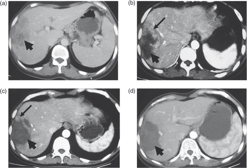 Figure 5. Transverse contrast-enhanced CT scans in patient 4. (a) Pre-ablation scan showed a 9.8 × 5.2-cm cancer nodule (indicated by the wide arrow). (b) Scan obtained one week after the first session of ablation showed an incomplete ablation (residual area indicated by the narrow arrow) with a 8.9 × 4.8-cm coagulation zone (indicated by the wide arrow). (c) Scan obtained two weeks after the second session of ablation showed an incomplete ablation (residual area indicated by the narrow arrow) with a 8.3 × 5.2-cm coagulation zone (indicated by the wide arrow). (d) Scan obtained two weeks after the third session of ablation showed a complete ablation with a 7.4 × 4.8-cm coagulation zone (indicated by the wide arrow).