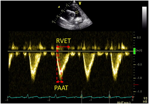 Figure 3. Right ventricular systolic time intervals. PAAT: pulmonary artery acceleration time; RVET: right ventricular ejection time.