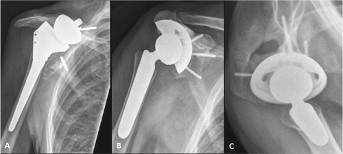 Figure 2. A 72-year-old man (patient 6) presented with severe pain and limited function 6 years after reverse shoulder arthroplasty for primary cuff-tear arthropathy. Shoulder radiographs at presentation showed loosening and migration of the baseplate (panel A). The prosthesis was revised using the CAD/CAM shoulder with significant pain relief and improvement in functional scores at the 36-month follow-up (panels B and C).