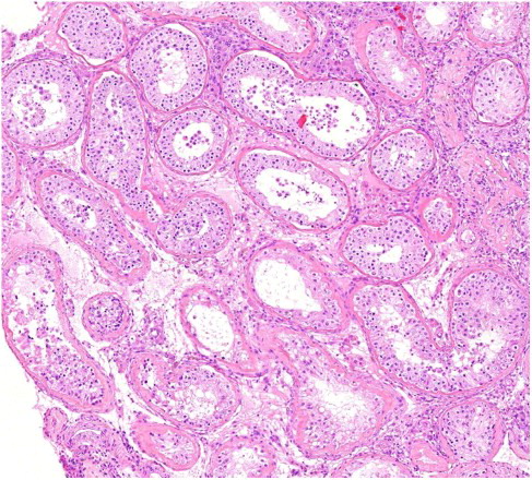 Figure 2.  Histological micrograph showing variation of spermatogenesis in different seminiferous tubules of the human testis from an azoospermic man (Photo: Bjarne Nielsen, Patological-anatomical Department, Vejle Hospital, Denmark).