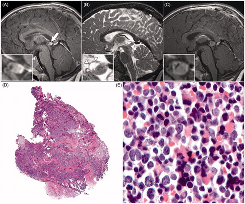 FIGURE 1. Sagittal T1-weighted magnetic resonance image (A) of the brain, showing a prominent pineal gland (arrow) with a multi-cystic anterior part and a solid posterior part. Sagittal T2-weighted magnetic resonance image (B), showing a fine nodular aspect of the cystic wall (arrowheads). The T1-weighted magnetic resonance image (C) shows prominent contrast enhancement of the solid part of the pineal gland combined with an increase in diameter compared with image (A). The histopathologic view (D) of the pineal tumor tissue stained with hematoxylin and eosin shows no necrosis or microvascular proliferation (original magnification × 2.5). At a higher magnification (E) moderately polymorphous cells with little cytoplasm and relatively large nuclei were visible; cells in a mitotic stage could easily be seen (original magnification × 40).