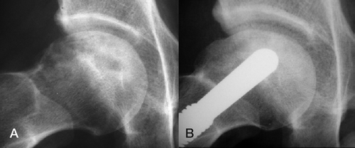 Figure 3. Right hip of a 38-year-old man with idiopathic osteonecrosis. A. Preoperatively, Steinberg stage IV with HHS of 63. B. 3.5 years later, Steinberg stage remained unchanged and HHS was 93.