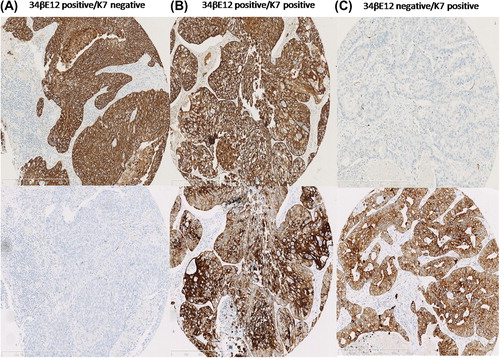 Figure 1. Immunohistochemical analysis of keratin expression pattern in non-small cell lung cancer (NSCLC); different cytoplasmic staining scores for tumor cell are shown. For K7, cores with tumor cell content of ≥ 10% staining were considered positive and tumors with ≥ 1% staining for 34βE12 were considered positive. (A) Tumor cells positive for 34βE12 and negative for K7 (34βE12+/K7+). (B) Tumor cells positive for 34βE12 and for K7 (34βE12+/K7+). (C) Tumor cells negative for 34βE12 and positive for K7 (34βE12-/K7+). (magnification 10×).