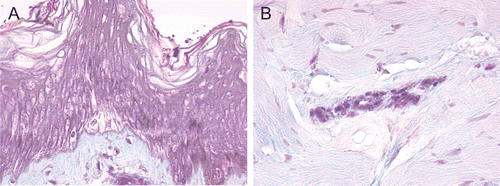 Figure 1.  (A) and (B) Exposed 70% HF, nonwashed explants, aspect at 24 h after a 20-sec exposure. Epidermis (A) and dermis (B). At 24 h after a 20-sec exposure, the epidermis presented completely necrotic structures with the appearance of coagulation necrosis. The lesions were less intense in the papillary and reticular dermis
