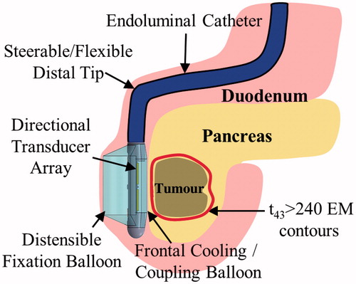 Figure 1. Schema and concepts of an endoluminal ultrasound applicator positioned in the GI tract for thermal therapy of pancreatic tumours. The applicator is illustrated as positioned in the duodenum for sonication of tumours in the head of the pancreas, following placement and insertion strategies common in endoscopy. Transducer arrays are configured for focused or diffuse patterns to provide a high degree of spatial control and volumetric heating.