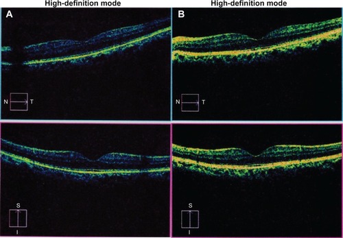 Figure 1 Spectral domain optical coherence tomography image of the left eye (A) before and (B) after phacoemulsification.