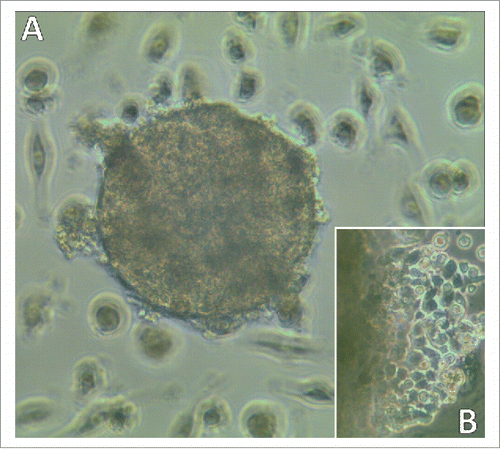 Figure 1. Light microscopy of a developing SCLC CTC-spheroid. Typical SCLC CTC in tissue culture appears as spheroid (A) which later shows outgrowth of adherent cells and shedding of cell fragments (B; left side shows border of the spheroid). Magnification: (A) 40fold and (B) 100fold.