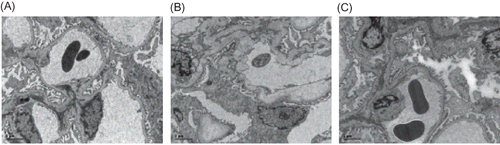 Figure 3. Electron microscopy of glomerulus at week 21 (×4200). (A) The ultrastructure of intact glomerulus was seen in the control group. (B) An ischemic shrinkage of the glomerular basement membrane was found in the model group. (C) A less severe ischemic shrinkage of the glomerular basement membrane was observed in Cozaar group.