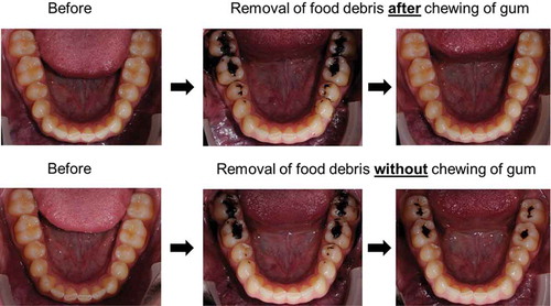 Figure 2. Removal of food debris (Oreo cookie, Nabisco, East Hanover, NJ, USA) from lower jaw occlusal surfaces by the chewing of gum (TOP row) and by natural oral cleansing mechanisms only without chewing of gum (BOTTOM row). A photograph was taken before consumption (LEFT column) and directly after consumption (MIDDLE column). Subsequently, the volunteer was requested to chew regular sugar-free gum for 2 min (TOP row) or wait for 2 min without the chewing of gum (BOTTOM row) and a third photograph was taken afterwards, illustrating the difference in removal of food debris (RIGHT column). Photographs taken with thanks to the Department of Orthodontics, University Medical Center Groningen, The Netherlands.