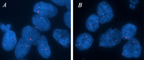 Figure 1.  FISH analyses of LRIG1 locus in colorectal cancer cells from two patients. (A) Nuclei showing normal gene copy number (two copies per nucleus) of the LRIG1 gene. (B) Nuclei showing increased gene copy number (more than two copies per nucleus) of the LRIG1 gene at 3p14. Analysis was performed with a specific LRIG1 probe (red).