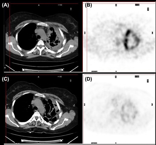 Figure 1. CT demonstrates a partial response to pazopanib (C) based on RECIST criteria (vs. baseline A). PET demonstrates a decrease in tumor metabolic activity (D vs. B).