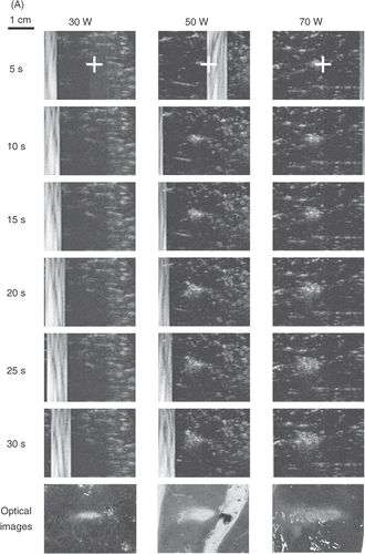 Figure 2. Real-time monitoring of the lesion-formation process in bovine liver blocks for (A) a 3.5 MHz HIFU transducer at electrical powers of 30, 50, and 70 W. For each power level, B-mode US images were captured after 5, 10, 15, 20, 25, and 30 s of HIFU exposure. The last row shows the optical images of lesions after ablation was completed. Note that no hyperechoes were evident throughout ablation at 30 W. (B) Real-time monitoring of the lesion-formation process in bovine liver blocks for a 1 MHz HIFU transducer at electrical powers of 50, 70, and 90 W. For each power level, B-mode US images were captured after 5, 10, 15, 20, 25, and 30 s of HIFU exposure. Note that no hyperechoes were evident throughout ablation at 50 W. The HIFU transducer was on the left side and the US scanner head was at the top. The ‘+’ represents the focal points of the HIFU transducer. The vertical stripes on most US images, e.g. all images of 3.5 MHz and 30 W, represent the strong acoustic waves from the HIFU transducer picked up by the diagnostic probe.
