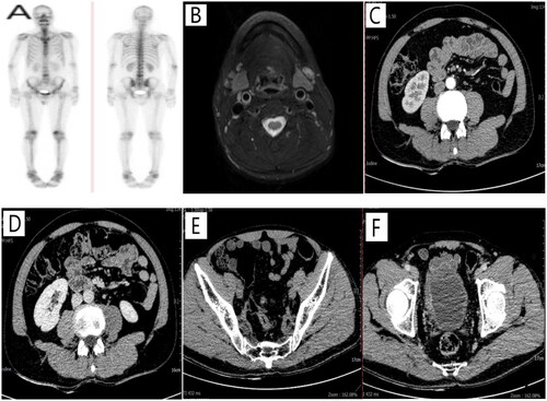 Figure 4. Partial imaging examinations after regular chemotherapy. (A) whole-body bone tomography showed that the bone salt metabolism of the lumbar 1–4 vertebrae was lower than before, the density was higher than before, and the range of osteogenesis was expanded. (B) Magnetic resonance imaging of the neck showed that multiple enlarged lymph nodes were seen in the neck area IV and the left clavicle fossa, both D1WI and T2WI showed high signal, abnormal lymph nodes were considered. (C,D) Whole abdominal CT showed abnormal abdominal lymph nodes disappeared. (E,F) Whole abdominal CT showed abnormal pelvic lymph node disappeared.