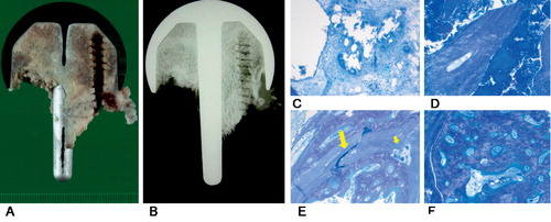 Figure 2.  A. Well-fixed femoral component, narrow superficial zone of cement penetration, and irregular fracture line were apparent macroscopically on the cut plane. B. Absence of vital reaction to the screw was evident by contact radiography several weeks after the procedure. C. Cement granulomas and fibrosis were found at the bone-cement interface. D. Bone trabeculae without stainable osteocytes and precipitations of calcium salts were found in the vicinity of the screw and of the fracture line. E. Bone tissue fragments from femoral neck distally to the fracture line revealed several fractured individual bone trabeculae (long arrow) with formation of microcallus and focal resorptive changes (short arrow). F. Broad fracture callus within the isolated bone fragments from femoral neck distal to the fracture line.