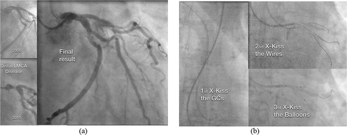 Figure 1. (a) Case 1. Caudal right anterior oblique (RAO) coronary angiograms obtained in 2005 and 2015 revealing the appearance of a severe Medina 1,1,1 LMCA lesion. Result after provisional stenting. (b) Case 1. A triple X-kiss pattern is discovered at the balloons, Wires and Guiding catheters levels. Balloons and wires X-kissing was unexpected.