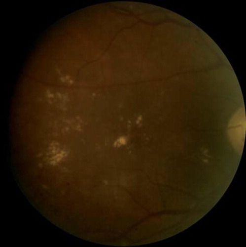 Figure 3. Fundus photograph demonstrating accumulation of lipid exudates in a patient with clinically significant diabetic macular edema.
