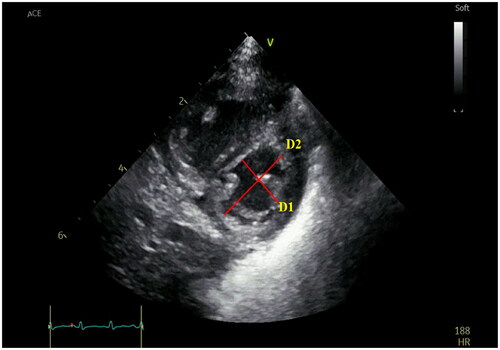 Figure 4. LV systolic eccentricity index (LV-sEI). The LV-sEI was obtained at the level of the parasternal left ventricular short-axis papillary muscle. LVsEI = D1 (LV internal diameter parallel to the IVS)/D2 (LV internal diameter perpendicular to the IVS).