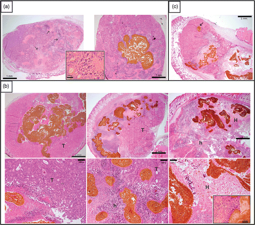 Figure 2. Microphotographs at D2 (with or without implant injection at D0 and hyperthermic treatment at D1). Panel (a) shows at left the control Co112 tumor, with non-induced necrosis (arrow) that typicaliy did not exhibit an inflammatory reaction (insert), and at right the control with the nonheated implant shown in brown. Panel (b) displays three treated tumors at low magnification in the upper row and at higher magnification in the lower row. On the left, a tumor treated with a magnetic field strength of 10 mT (MET = 39.5°C, AUC = 152.8°C1 min) leaving most of viable tumor tissue (T) without any heat-inducec1 necrosis. In the middle, a tumor treated with a magnetic field strength of 10.5 mT (MET = 44.0°C, AUC = 211.8°C1min) shows clear heat-induced necrosis (h) around the implant, but more distant tumor tissue remains viable. On the right, a tumor treated with a magnetic field strength of 12 mT (MET = 46.2°C, AUC = 284.3°C1min) illustrates heat induced necrosis (h) covering most of the tumor and effecting intense thermal damage (H) in the vicinity of implant, accompanied by an inflammatory reaction (neutrophils and macrophages, see insert). Pane! (c) illustrates the topographic association between implant and heat-induced necrosis. A small isolated extension of the implant (arrow) did not trigger heat damage, in contrast to the more voluminous main body of the implant.