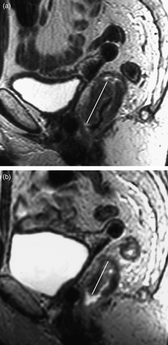 Figure 2.  Sagittal T2 weighted MRI through rectal tumour (a) before and (b) after short course radiotherapy showing reduction in tumour length post treatment. In this case, tumour length reduced by 33% following short course radiotherapy.