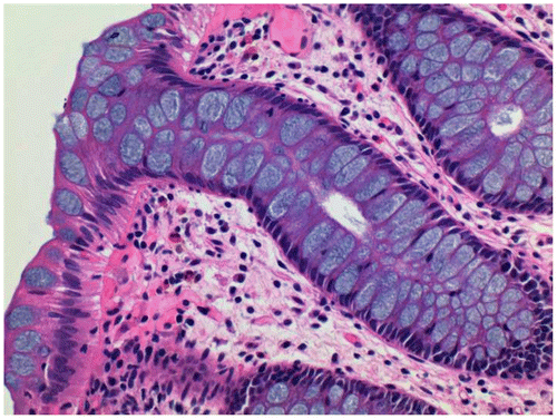 Figure 3 Rectal biopsy stained with Gill’s B hematoxylin and eosin–phloxine, ×40. Mucin is stained blue.