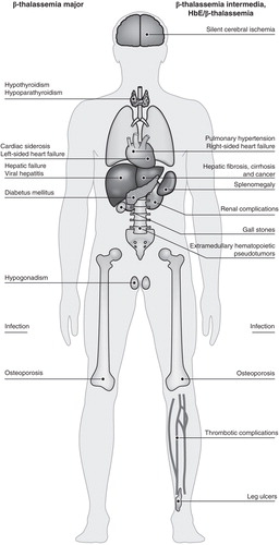 Figure 2. Major complications observed in patients with either transfusion-dependent or non-transfusion-dependent β-thalassemia. Patients with β-thalassemia intermedia or HbE/β-thalassemia exhibit a unique profile of complications compared with those with β-thalassemia major, although several complications including osteoporosis, endocrinopathies and hepatic complications, are observed across all patient types.