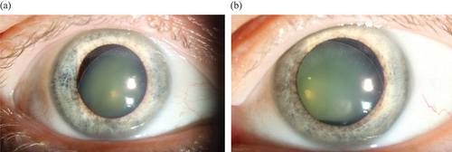 Figure 1. 1a and 1b Patient with homocystinuria, 60 years of age, with bilateral ectopia lentis (subluxated lenses) and severe myopia.