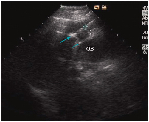 Figure 1. The MW antenna (long arrow) was placed into the tumour and thermal monitoring needle (short arrow) was placed into the tumour margin proximal to the gallbladder (GB) for real-time temperature monitoring during the MW ablation.