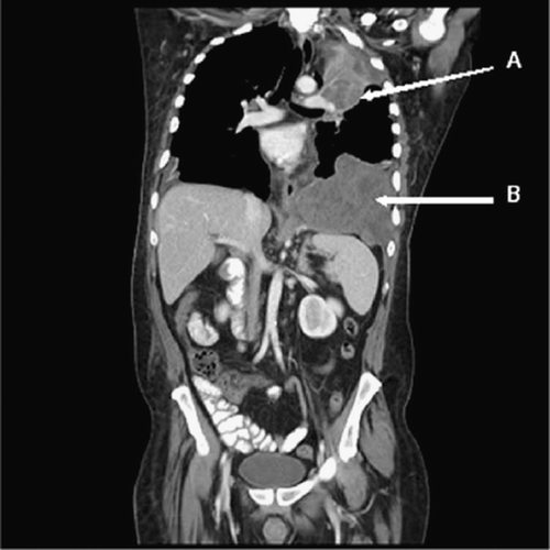 Figure 1. CT scan performed on 2/26/08 prior to sunitinib therapy. The pleural (A) and diaphragmatic (B) tumors measured 89 mm and 105.5 mm, respectively, in the vertical dimension.